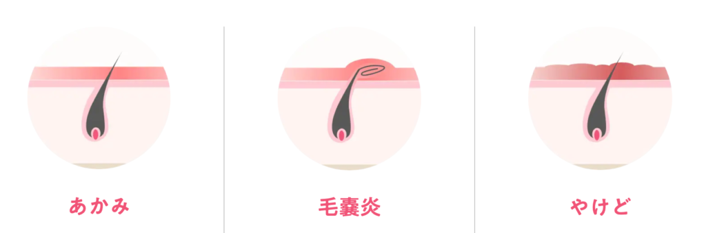 医療脱毛リスク
