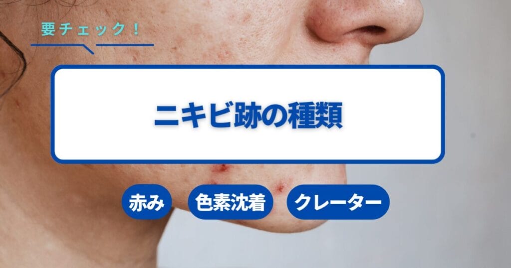 ニキビ跡の種類